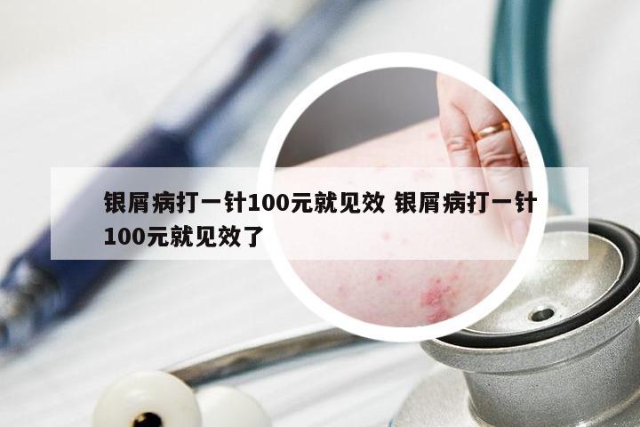 银屑病打一针100元就见效 银屑病打一针100元就见效了