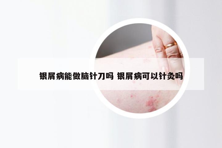 银屑病能做脑针刀吗 银屑病可以针灸吗