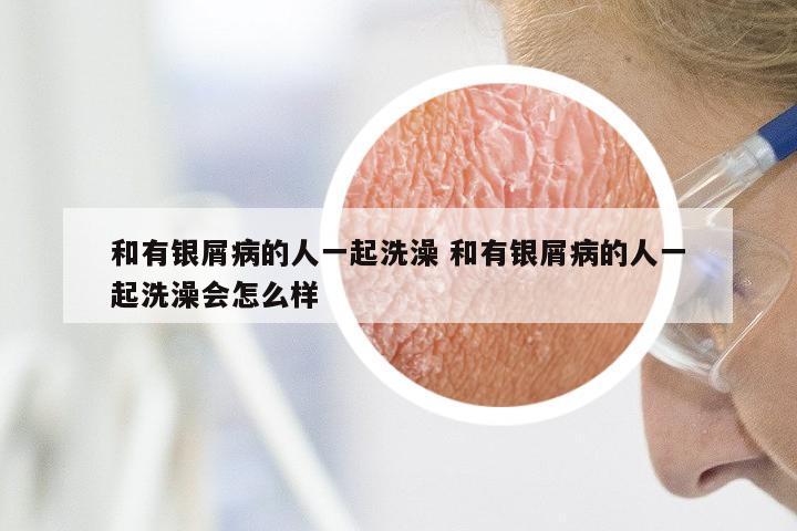 和有银屑病的人一起洗澡 和有银屑病的人一起洗澡会怎么样