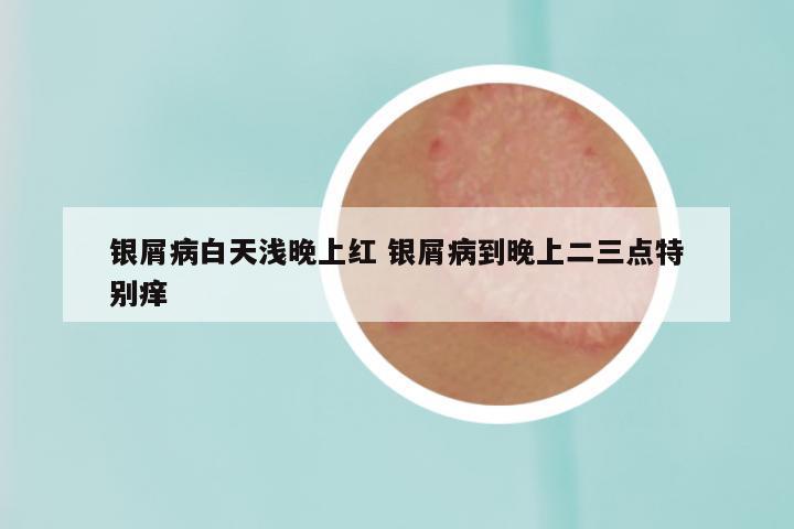 银屑病白天浅晚上红 银屑病到晚上二三点特别痒