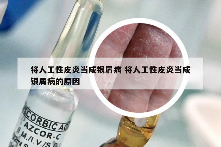 将人工性皮炎当成银屑病 将人工性皮炎当成银屑病的原因