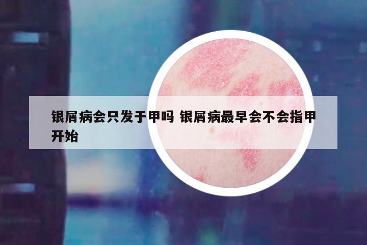银屑病会只发于甲吗 银屑病最早会不会指甲开始