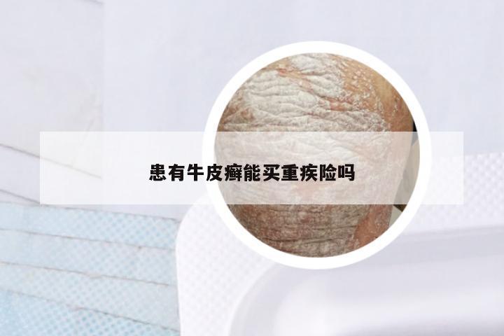 患有牛皮癣能买重疾险吗