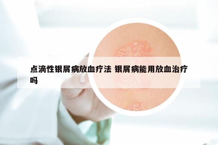 点滴性银屑病放血疗法 银屑病能用放血治疗吗
