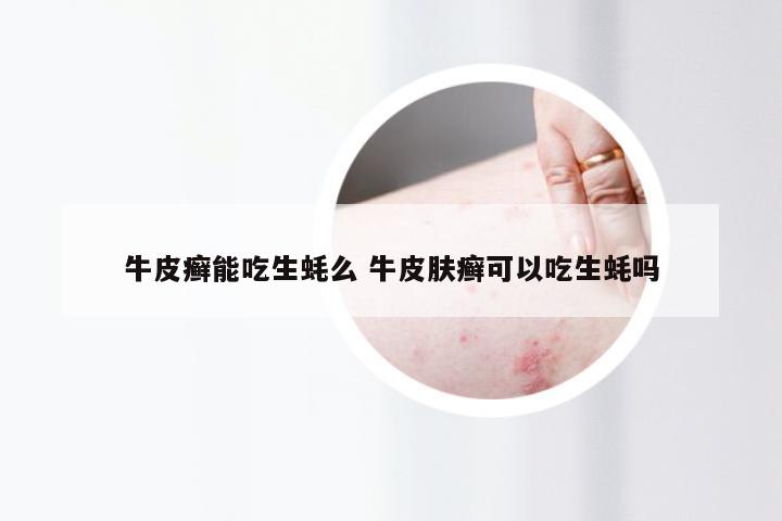 牛皮癣能吃生蚝么 牛皮肤癣可以吃生蚝吗