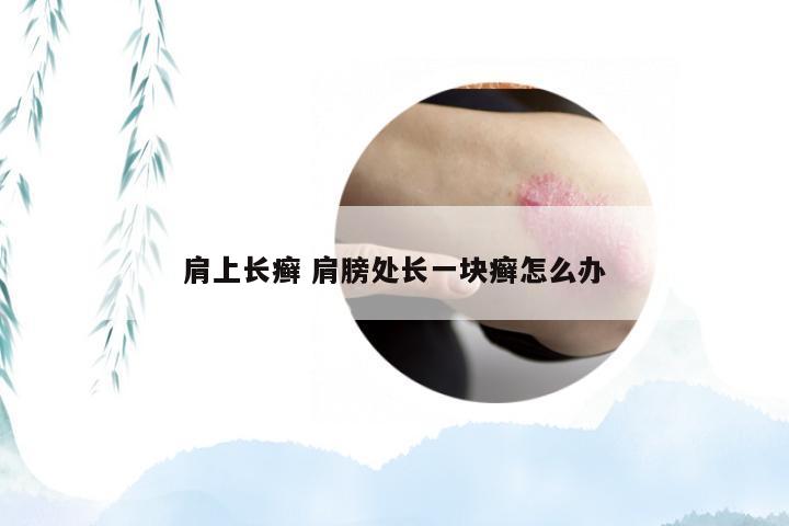 肩上长癣 肩膀处长一块癣怎么办