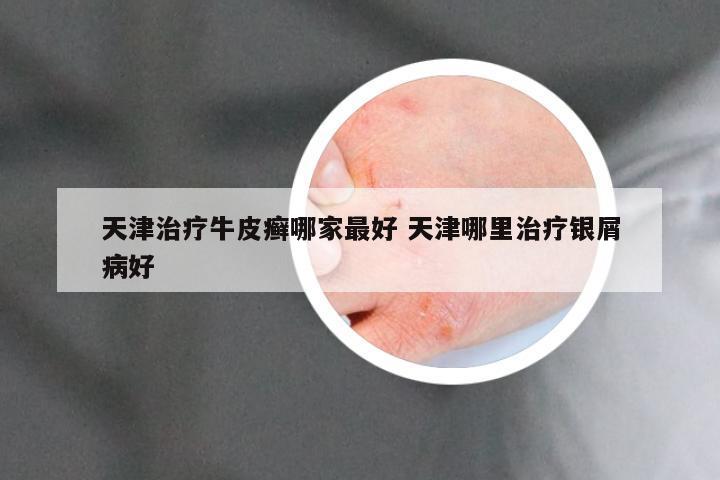 天津治疗牛皮癣哪家最好 天津哪里治疗银屑病好