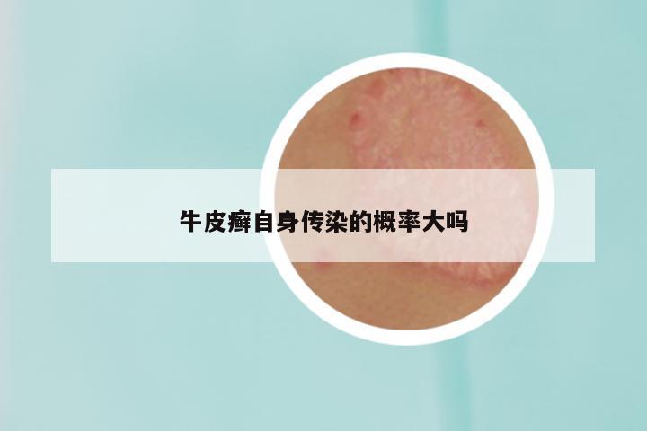 牛皮癣自身传染的概率大吗
