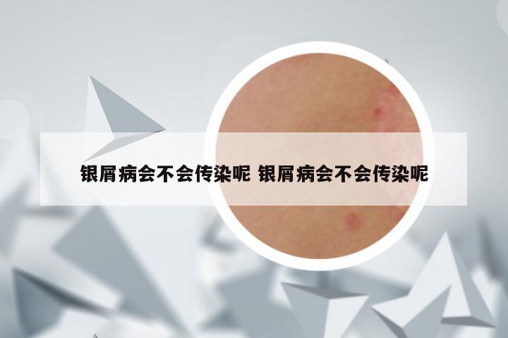 银屑病会不会传染呢 银屑病会不会传染呢