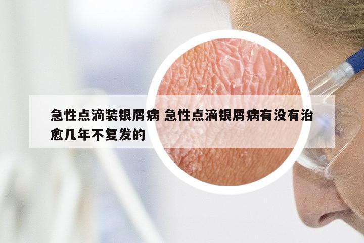 急性点滴装银屑病 急性点滴银屑病有没有治愈几年不复发的