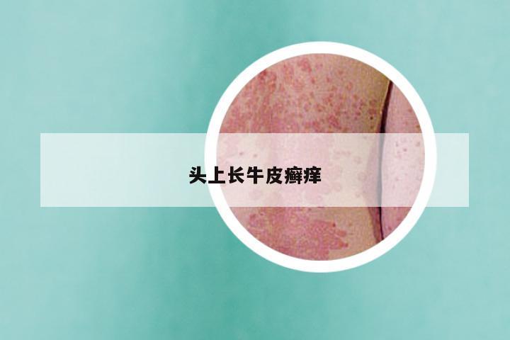 头上长牛皮癣痒
