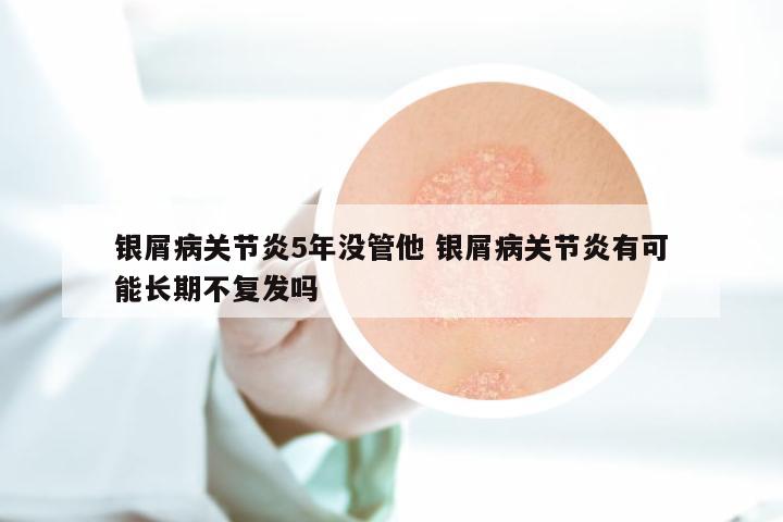 银屑病关节炎5年没管他 银屑病关节炎有可能长期不复发吗