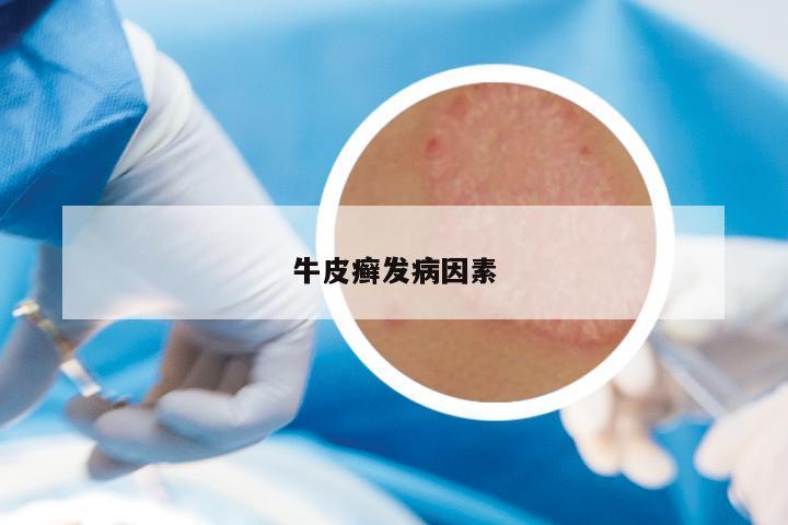 牛皮癣发病因素