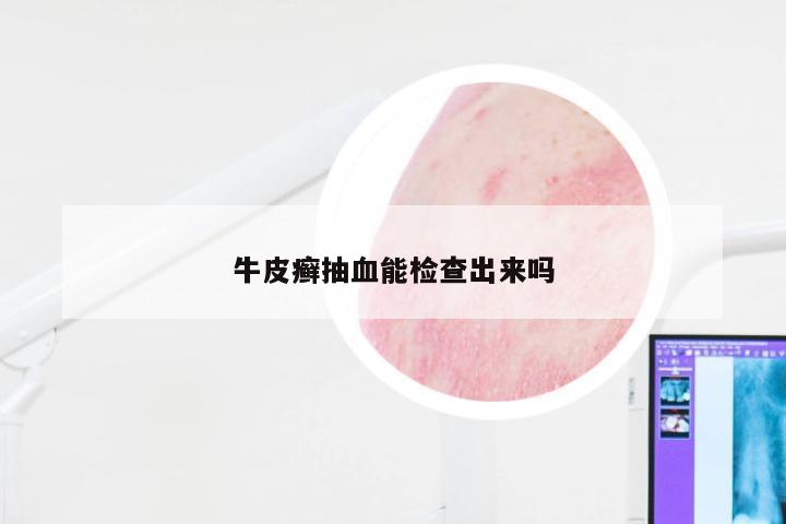 牛皮癣抽血能检查出来吗