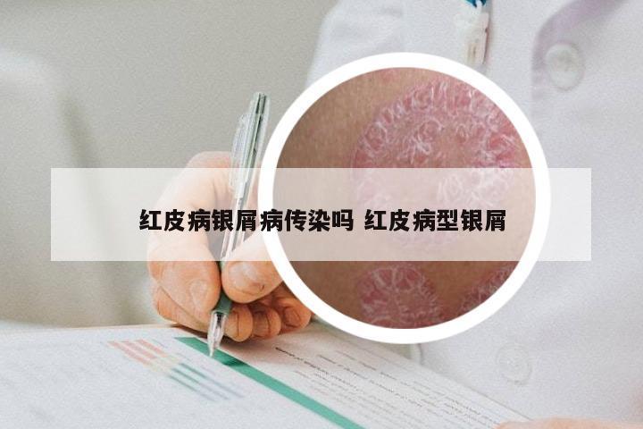 红皮病银屑病传染吗 红皮病型银屑