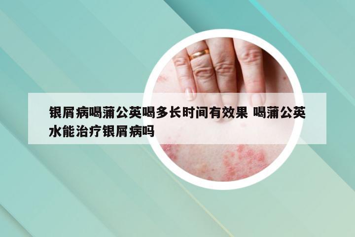 银屑病喝蒲公英喝多长时间有效果 喝蒲公英水能治疗银屑病吗