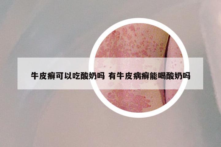 牛皮癣可以吃酸奶吗 有牛皮病癣能喝酸奶吗