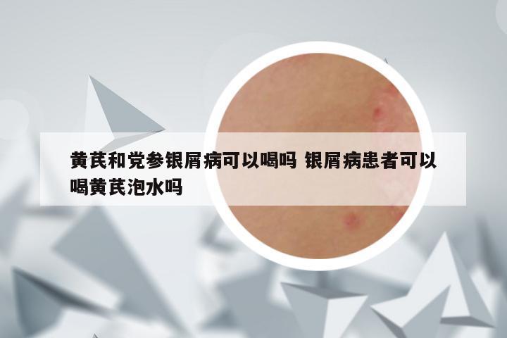 黄芪和党参银屑病可以喝吗 银屑病患者可以喝黄芪泡水吗