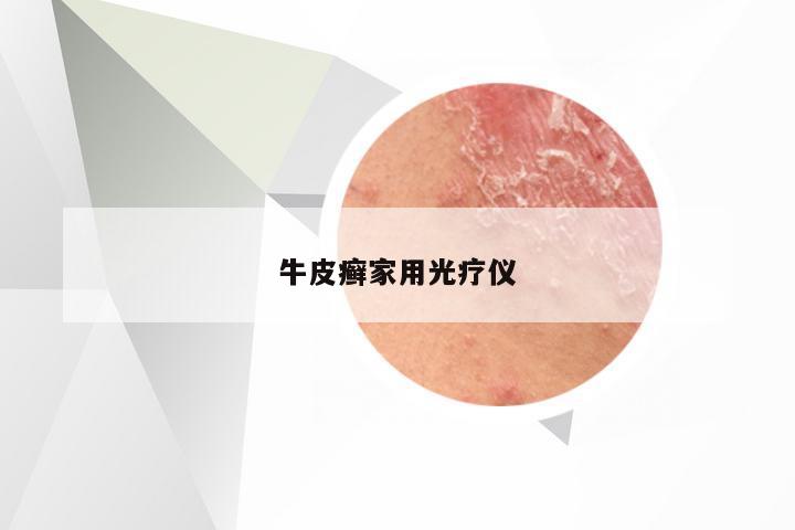 牛皮癣家用光疗仪