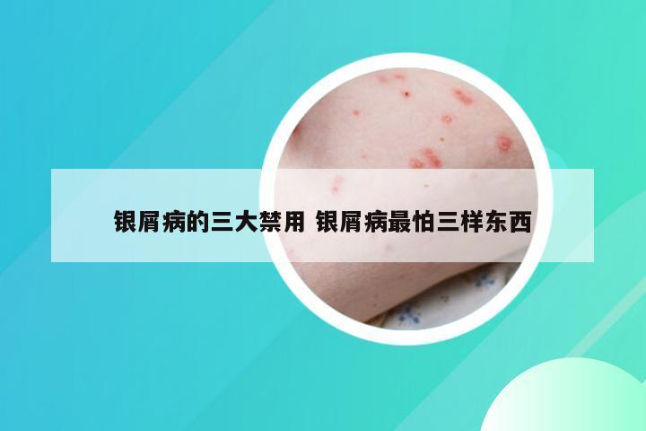 银屑病的三大禁用 银屑病最怕三样东西