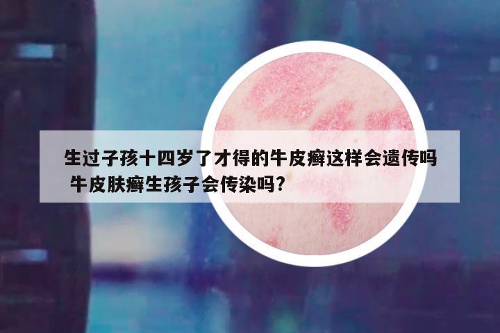生过子孩十四岁了才得的牛皮癣这样会遗传吗 牛皮肤癣生孩子会传染吗?