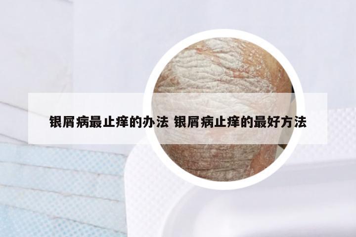 银屑病最止痒的办法 银屑病止痒的最好方法