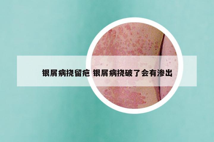 银屑病挠留疤 银屑病挠破了会有渗出