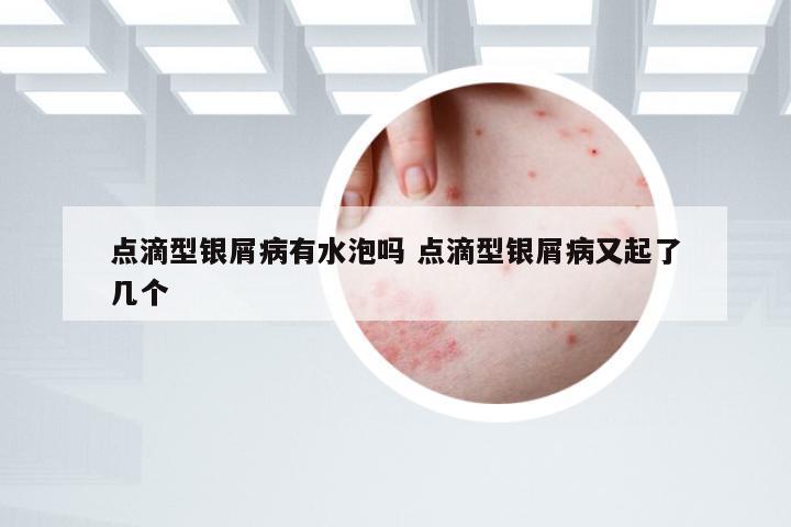 点滴型银屑病有水泡吗 点滴型银屑病又起了几个