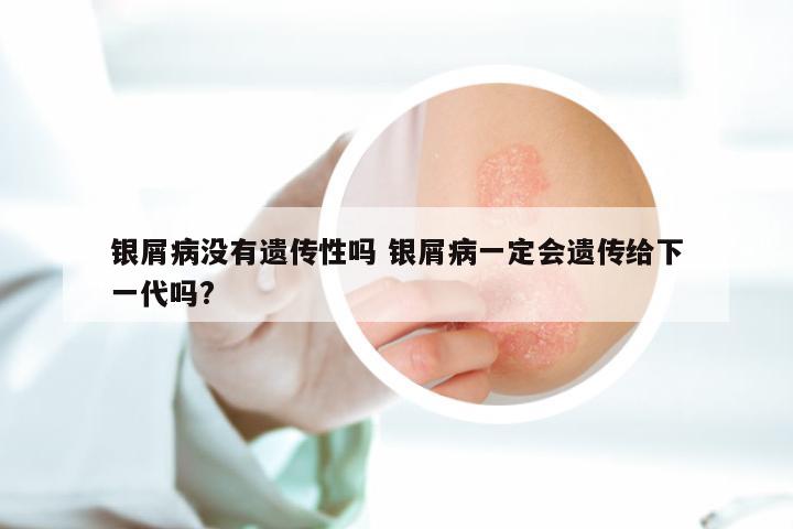 银屑病没有遗传性吗 银屑病一定会遗传给下一代吗?