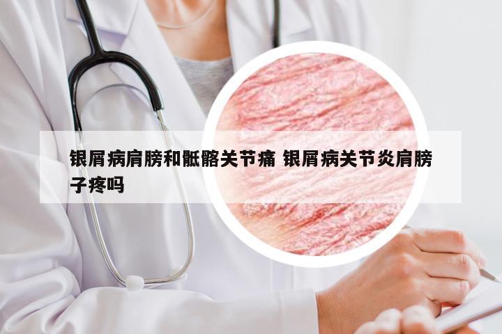 银屑病肩膀和骶髂关节痛 银屑病关节炎肩膀子疼吗