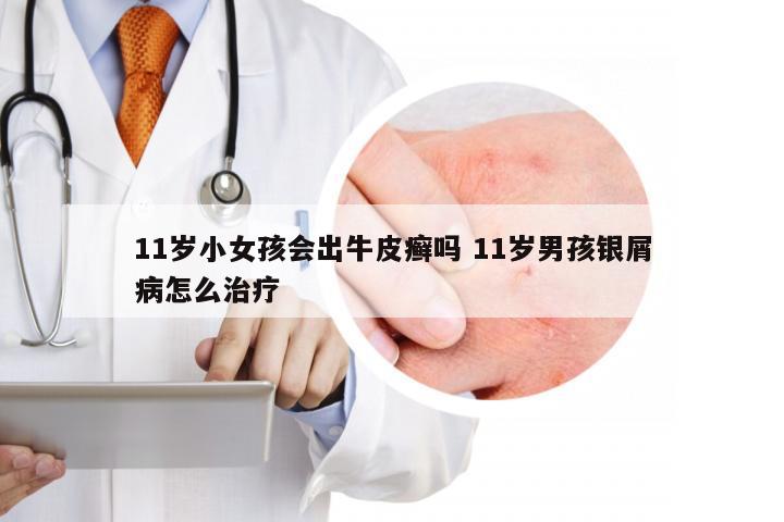11岁小女孩会出牛皮癣吗 11岁男孩银屑病怎么治疗