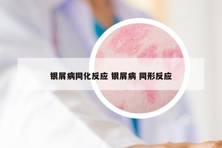 银屑病同化反应 银屑病 同形反应