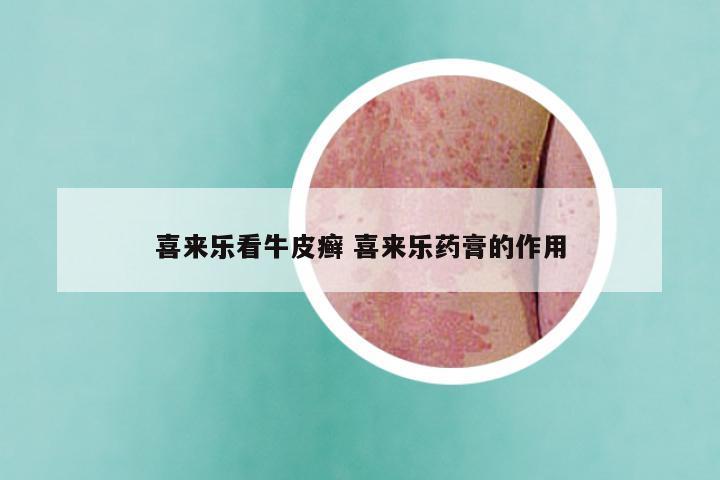 喜来乐看牛皮癣 喜来乐药膏的作用
