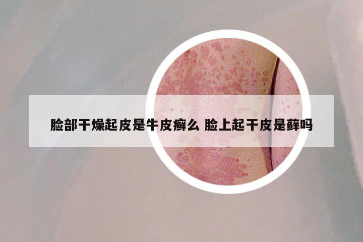 脸部干燥起皮是牛皮癣么 脸上起干皮是藓吗