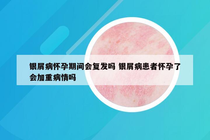 银屑病怀孕期间会复发吗 银屑病患者怀孕了会加重病情吗
