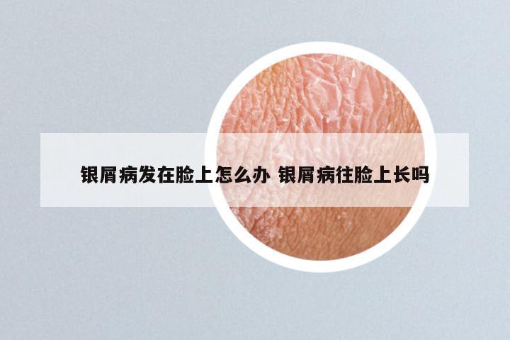银屑病发在脸上怎么办 银屑病往脸上长吗