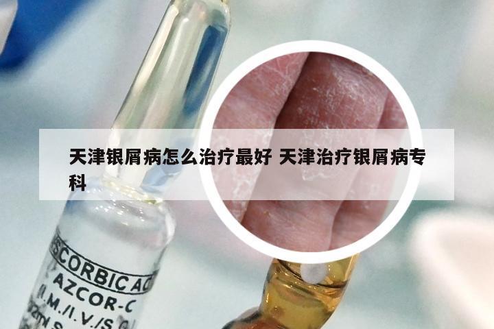 天津银屑病怎么治疗最好 天津治疗银屑病专科