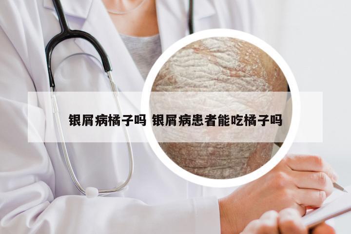 银屑病橘子吗 银屑病患者能吃橘子吗