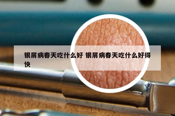 银屑病春天吃什么好 银屑病春天吃什么好得快