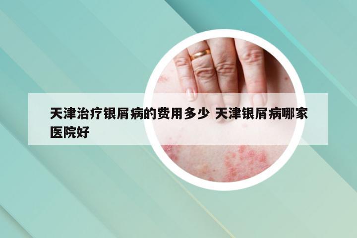 天津治疗银屑病的费用多少 天津银屑病哪家医院好
