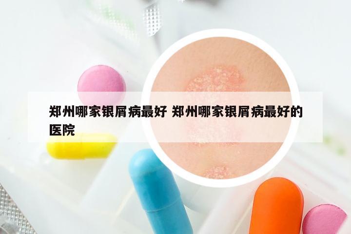 郑州哪家银屑病最好 郑州哪家银屑病最好的医院
