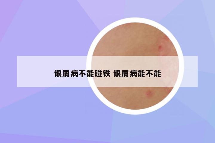 银屑病不能碰铁 银屑病能不能