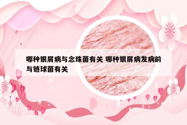 哪种银屑病与念珠菌有关 哪种银屑病发病前与链球菌有关