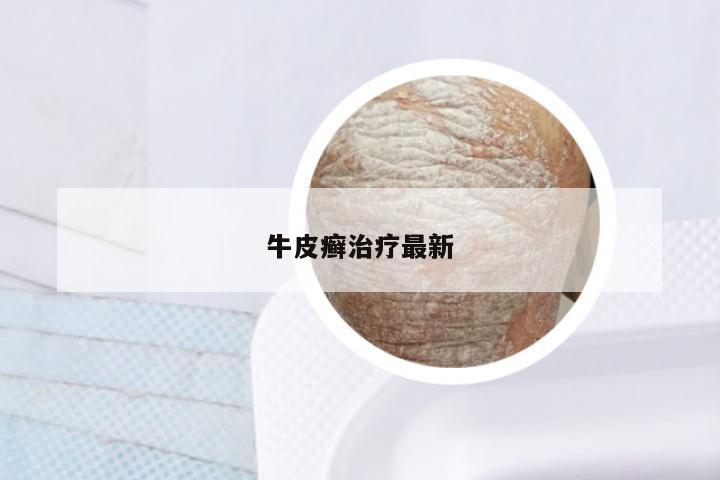 牛皮癣治疗最新