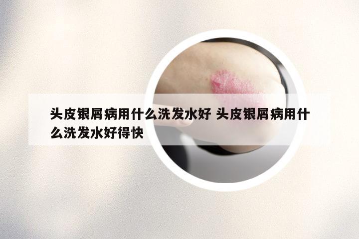 头皮银屑病用什么洗发水好 头皮银屑病用什么洗发水好得快