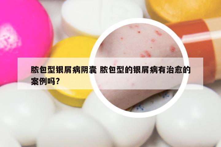 脓包型银屑病阴囊 脓包型的银屑病有治愈的案例吗?
