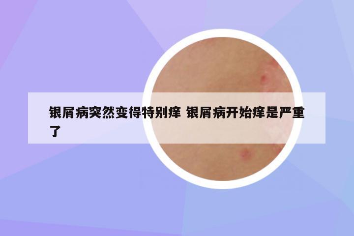 银屑病突然变得特别痒 银屑病开始痒是严重了