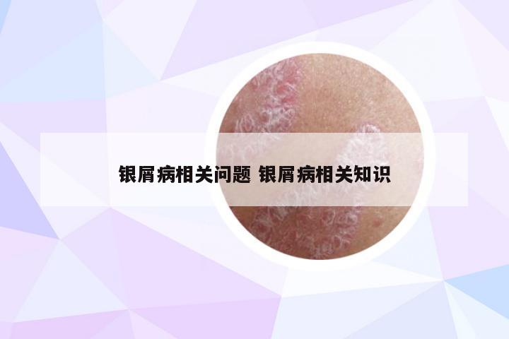 银屑病相关问题 银屑病相关知识