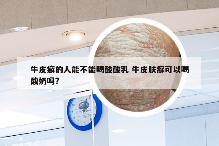 牛皮癣的人能不能喝酸酸乳 牛皮肤癣可以喝酸奶吗?
