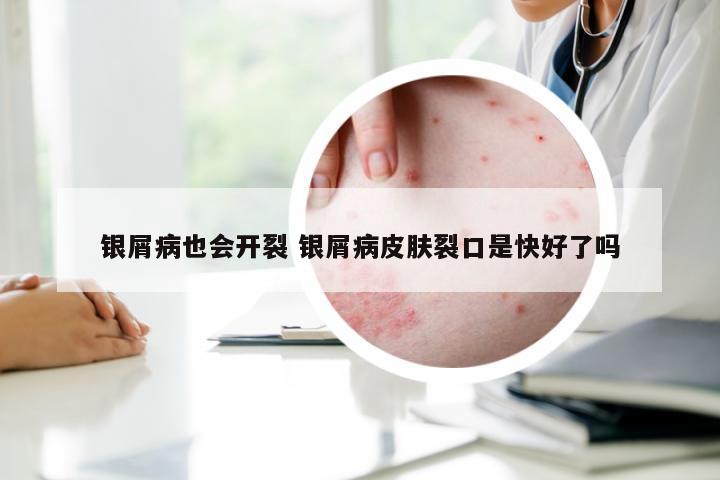 银屑病也会开裂 银屑病皮肤裂口是快好了吗